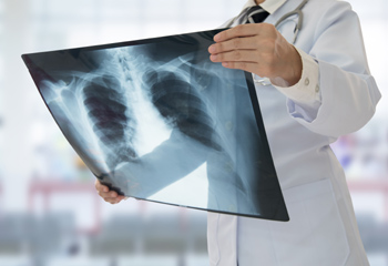 Foto cáncer de pulmón